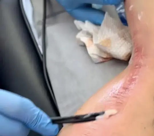 scar tattoo
