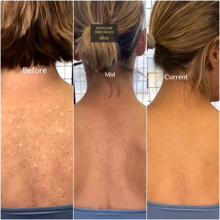 Progression of paramedical tattoo on a woman's back to conceal sun damage and hypopigmentation, featuring before, during, and after results.