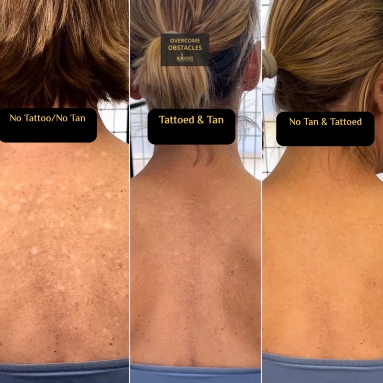 Visual explanation of tanning and scar camouflage tattoo through an actual case of a woman. The image showcases three stages: no tattoo with no tan, tanned with tattoo, and tattooed with no tan, highlighting the effectiveness of the procedure in blending scars with the skin tone.