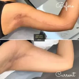 Before-and-after image of a brachioplasty scar concealed with paramedical tattooing, demonstrating the effectiveness of this treatment in reducing scar visibility.