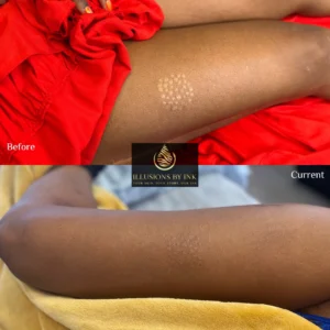 Before-and-after image of a thigh with multiple scars successfully concealed with paramedical tattooing.