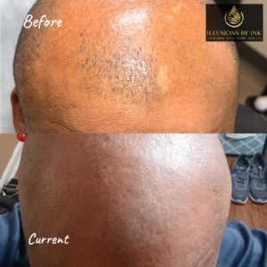 Before-and-after images show a man's head. The scars are well hidden with scar camouflage tattooing. This uses skin-tone ink.