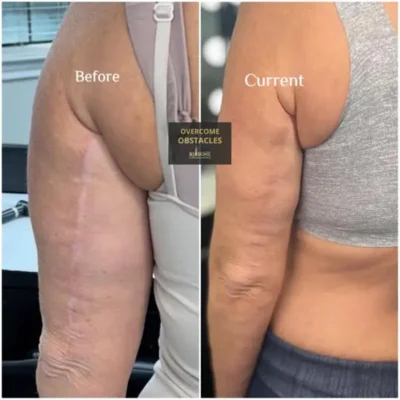 Before and after results of brachioplasty scar camouflage tattooing, expertly blending post-surgical scars with the natural skin tone at Illusions by Ink Studio