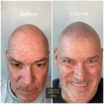 Before and after results of scalp micropigmentation (SMP) on a middle-aged man, creating the appearance of fuller hair at Illusions by Ink Studio.