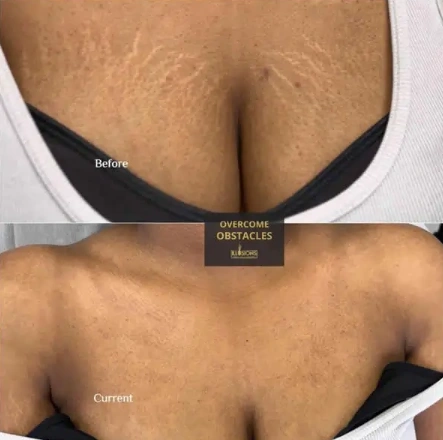 Before and after results of stretch mark camouflage tattooing on a Black woman's upper chest, expertly blending stretch marks for a flawless skin tone at Illusions by Ink Studio.