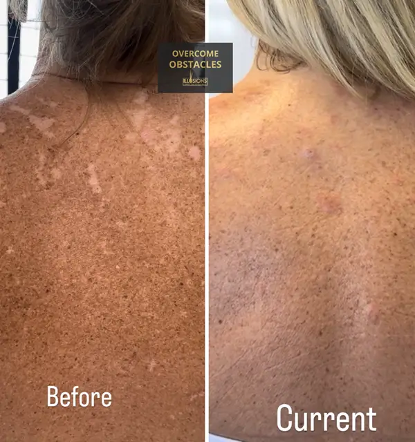 Before and after results of paramedical tattooing to conceal sun-damaged skin and sun spots, blending discoloration for a natural skin tone at Illusions by Ink Studio.