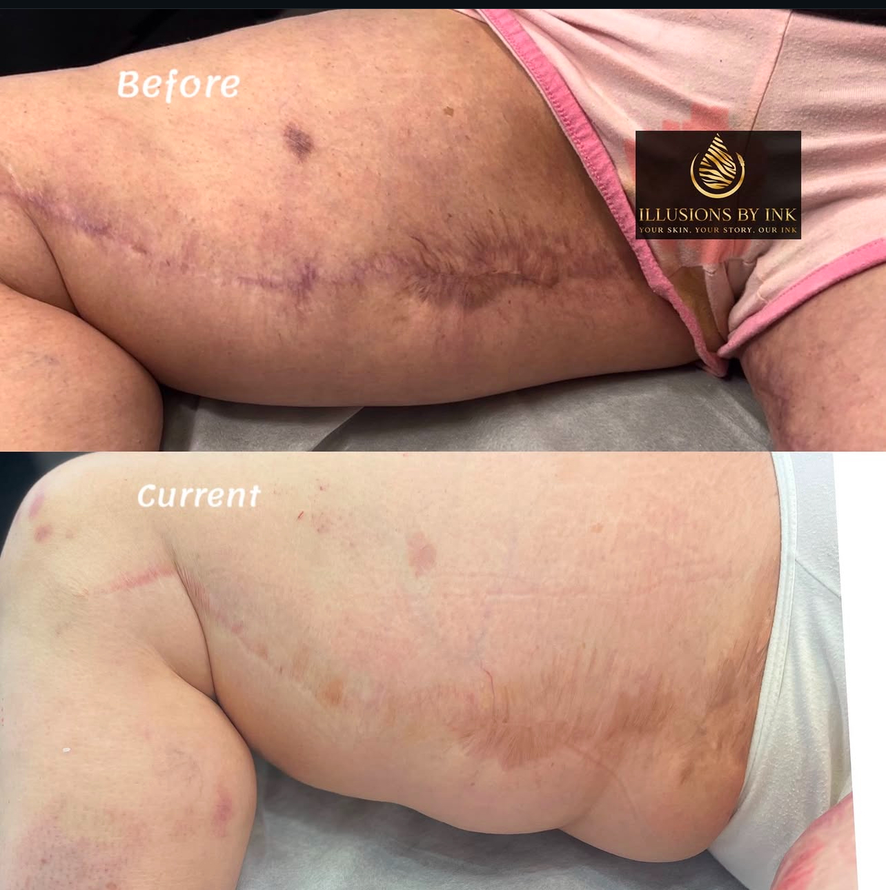 Before and after results of a thighplasty scar camouflage tattoo at Illusions by Ink Studio, showcasing the seamless blending of skin tone pigments to reduce scar visibility.