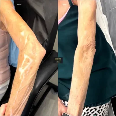 Before and after results of paramedical tattooing on an elderly woman’s arm, showing restored skin tone and reduced appearance of discoloration at Illusions by Ink Studio.