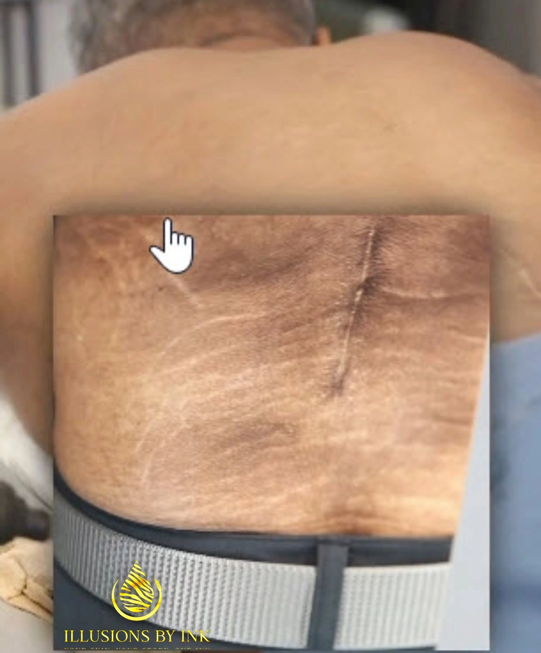 Before and after results of scar camouflage tattooing on a man's back, showing improved skin tone and reduced visibility of a large surgical scar.