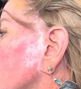 Close-up of a woman’s face showing visible hypopigmentation and scarring from necrosis before skin tone tattooing at Illusions by Ink Studio.