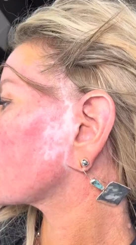 Close-up of a woman’s face showing visible hypopigmentation and scarring from necrosis before skin tone tattooing at Illusions by Ink Studio.