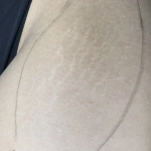 Close-up of a woman’s upper thigh and hip showing visible white stretch marks within outlined treatment area before camouflage tattooing.