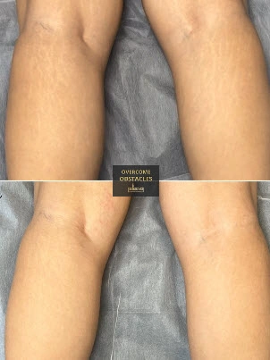 Before and after image of stretch mark camouflage tattoo on a client’s calves, showing visible improvement in skin tone blending after one session at Illusions by Ink Studio.