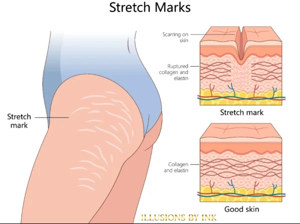 Diagram comparing stretch mark damage to healthy skin, showing collagen and elastin rupture beneath the surface.