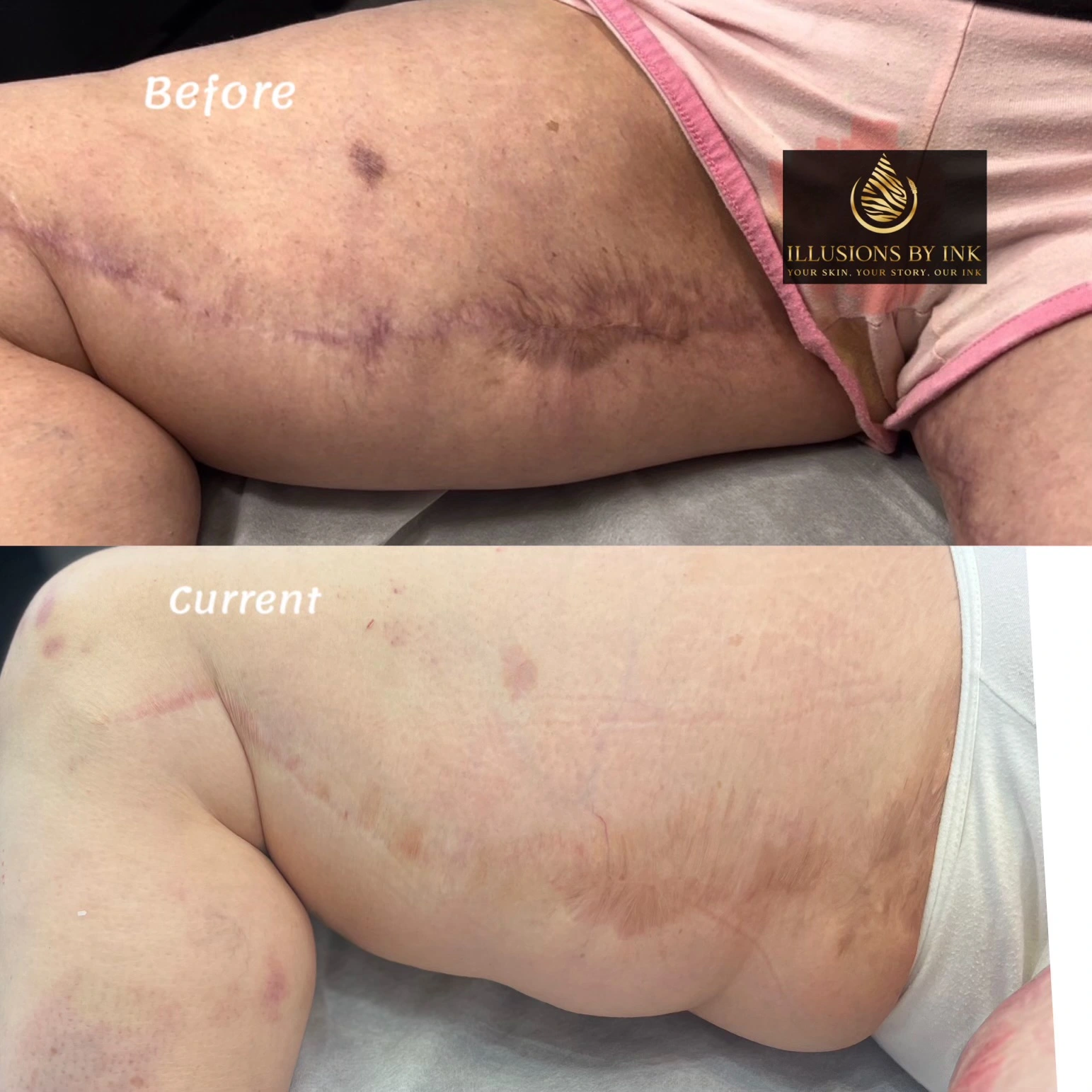 Before and after image showing a hyperpigmented thighplasty scar on a woman’s upper thigh, successfully camouflaged using skin tone tattooing at Illusions by Ink Studio.