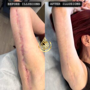 Extreme arm lift scar before-and-after image showing dramatic camouflage tattoo results by Illusions by Ink Studio in Dallas, Texas.