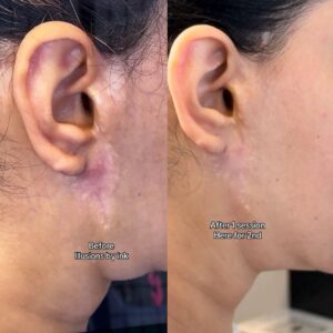 Before-and-after comparison showing improved camouflage of a facial reconstructive surgery scar near the ear after one paramedical tattoo session at Illusions by Ink Studio in Dallas, Texas.