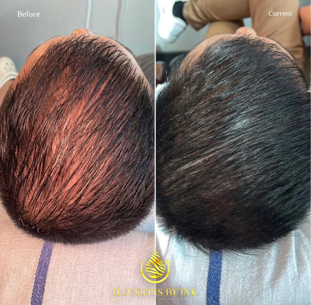 Before-and-after image showing scalp micropigmentation used to improve the appearance of thinning dark hair on the crown at Illusions by Ink Studio in Dallas, Texas.