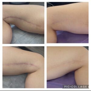 Before-and-after collage showing thigh lift scar camouflage tattoo results on the upper leg, performed by Illusions by Ink Studio in Dallas, Texas.
