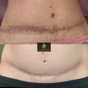 Before-and-after image showing tummy tuck scar camouflage results on the lower abdomen following a paramedical tattoo session at Illusions by Ink Studio in Dallas, Texas.