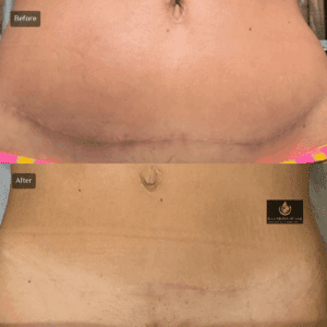 Before-and-after comparison of tummy tuck scar camouflage showing improved blending and softened scar appearance after paramedical tattooing at Illusions by Ink Studio in Dallas, Texas.