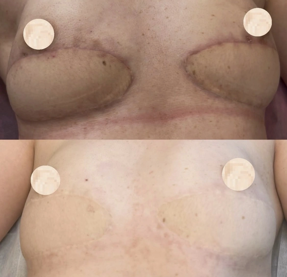 Before and current complex skin graft and reconstruction scar camouflage results on the chest using advanced custom pigment blending at Illusions by Ink Studio.