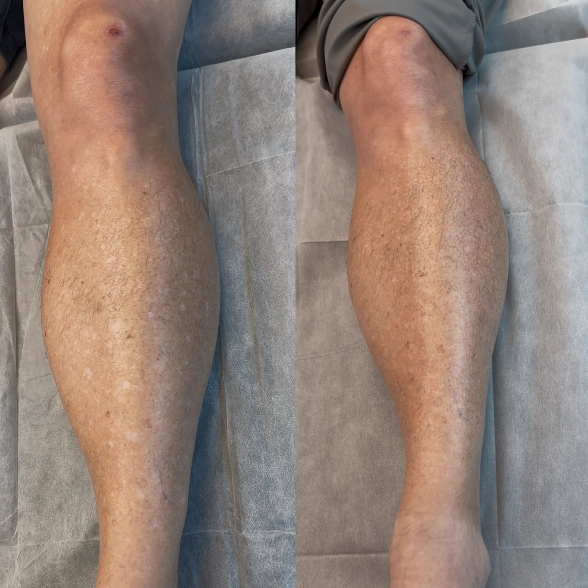 Before and 90-day healed view of confirmed IGH on a man's left lower leg after one camouflage session.