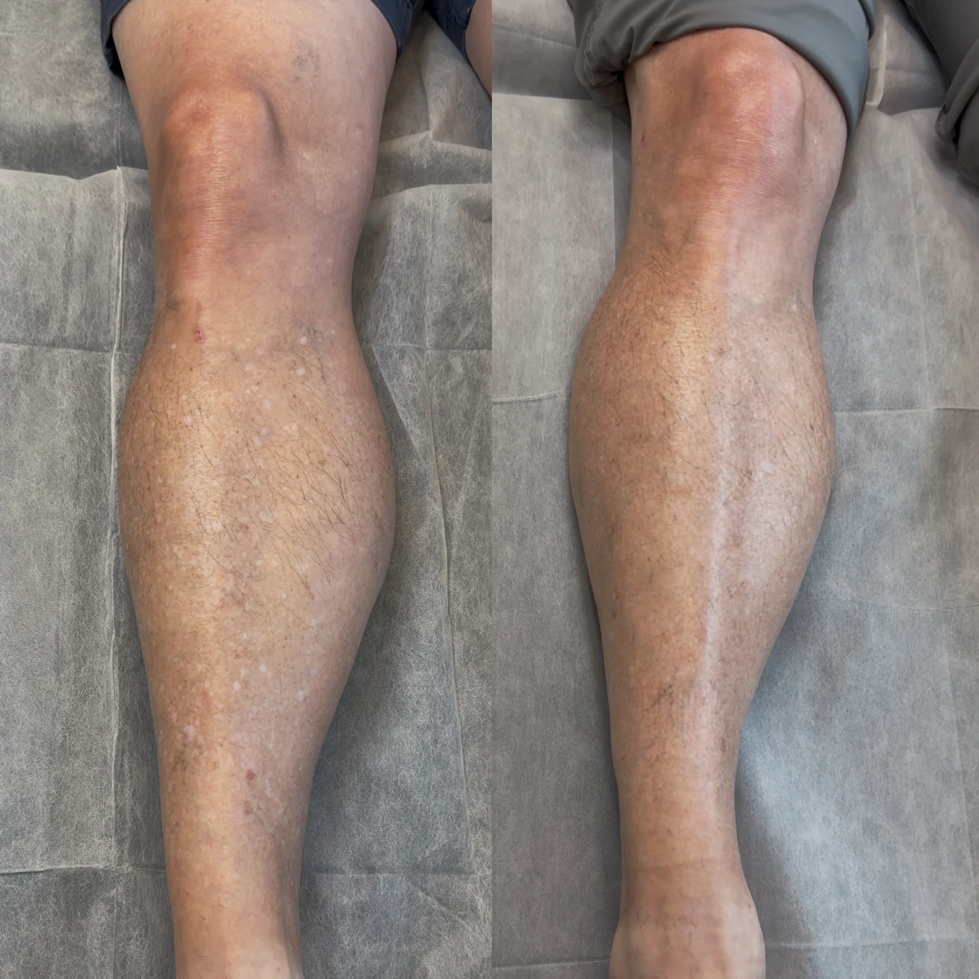 : Before and 90-day healed view of confirmed IGH on a man's right lower leg after one camouflage session.