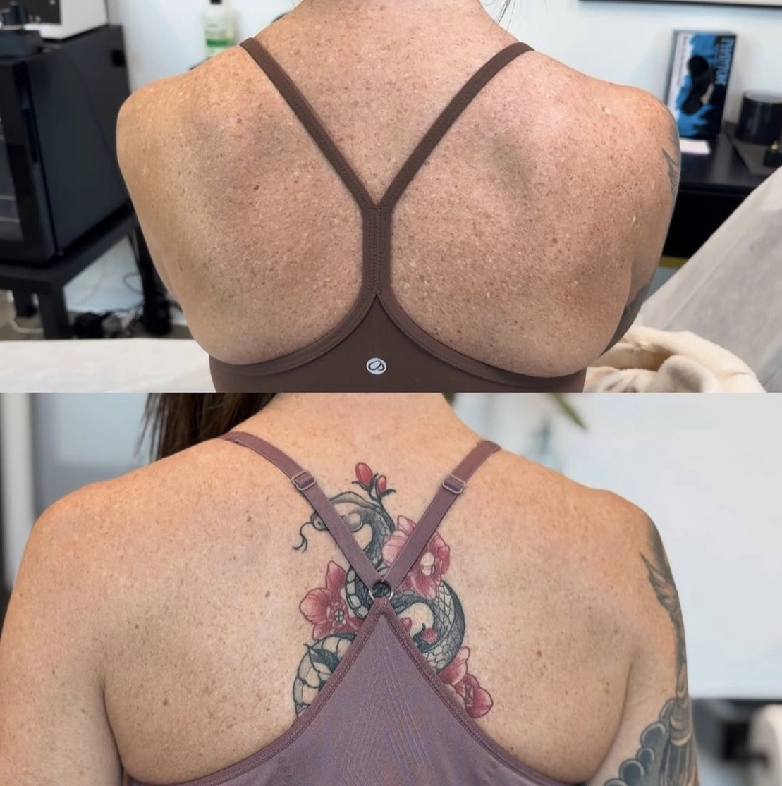 Before and approximately 9-month healed view of confirmed IGH on a woman's upper back after camouflage