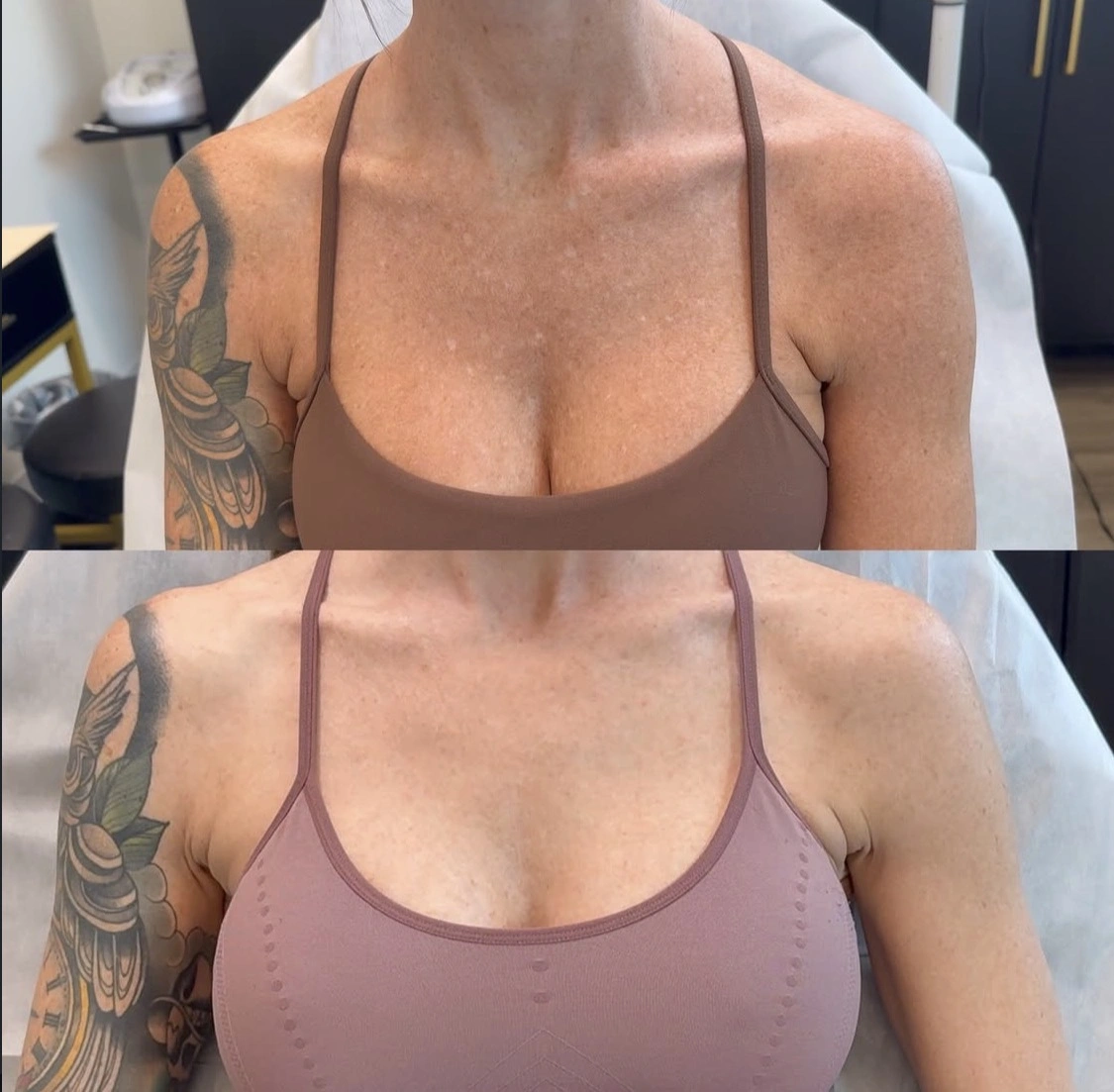 Before and approximately 9-month healed view of confirmed IGH on a woman's upper chest after paramedical tattoo camouflage
