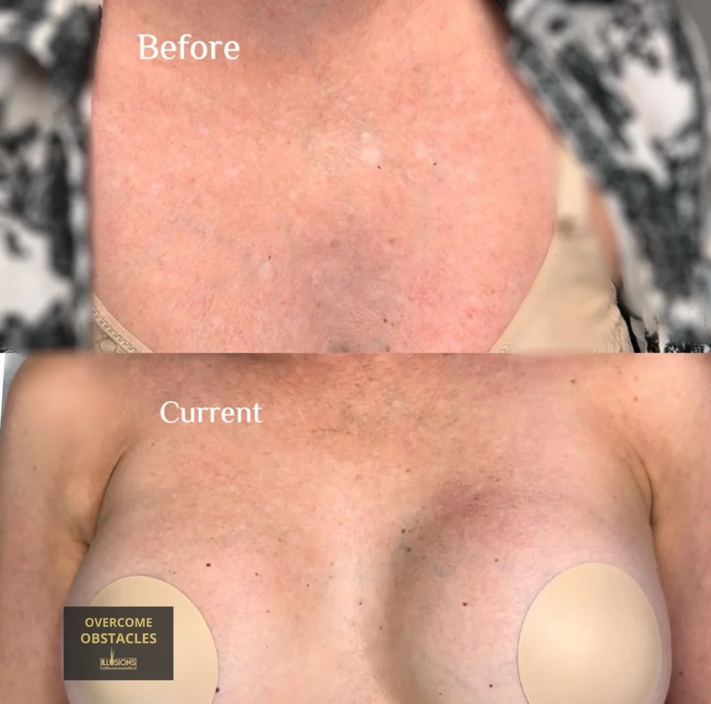 Before and current view of confirmed IGH on a woman's upper chest during paramedical tattoo camouflage