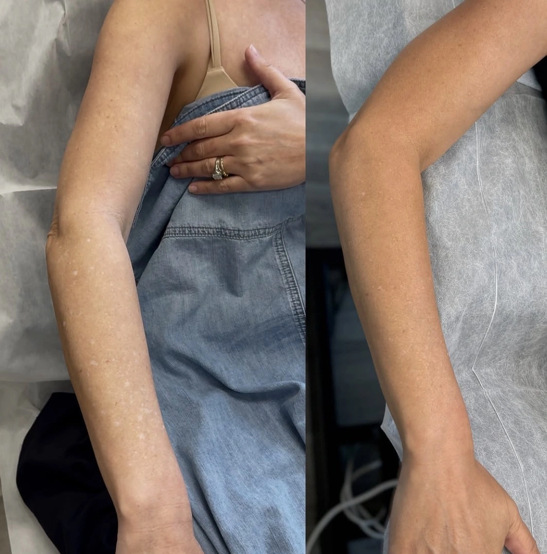 Before and current view of confirmed IGH on a woman's arm after skin-tone camouflage