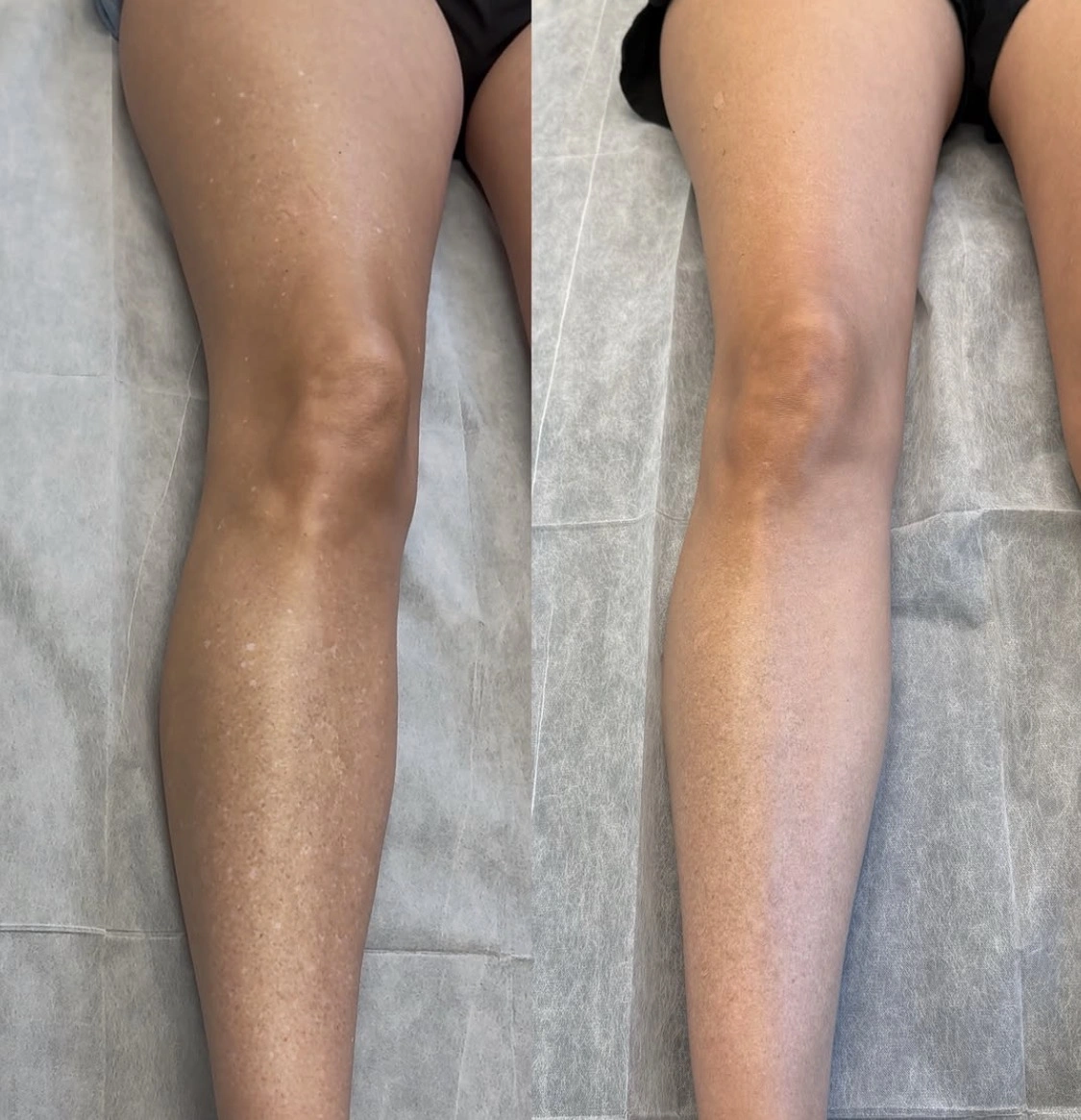 Before and current view of confirmed IGH on a woman's leg after skin-tone camouflage.