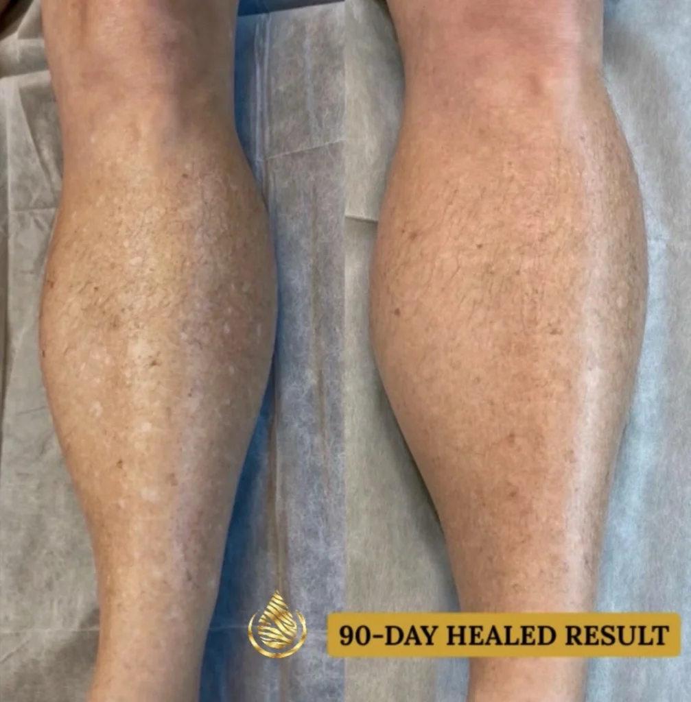 Before and 90-day healed view of confirmed IGH on a man's lower leg after one paramedical tattoo camouflage session