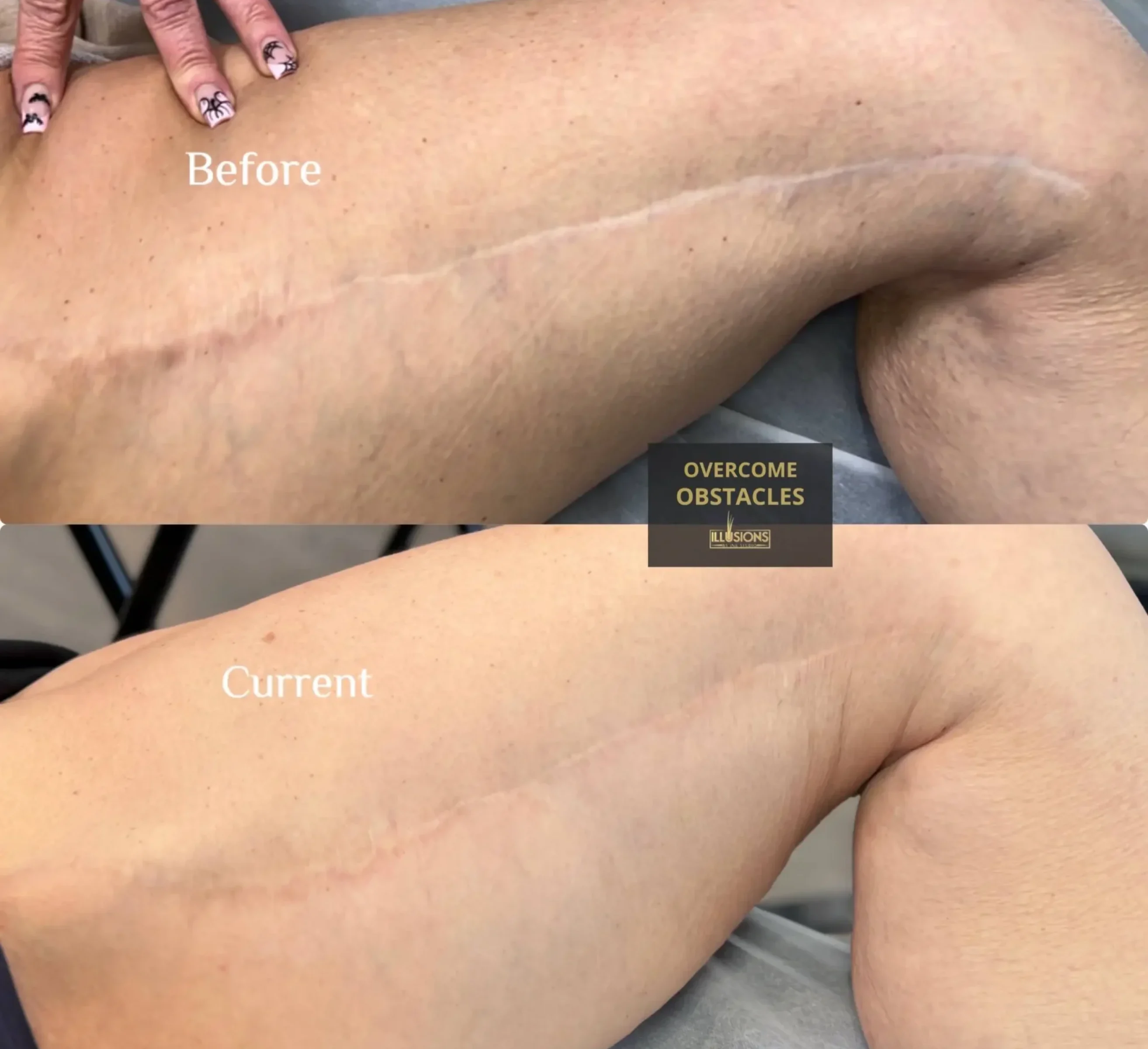 Thighplasty-left-leg-before-and-after