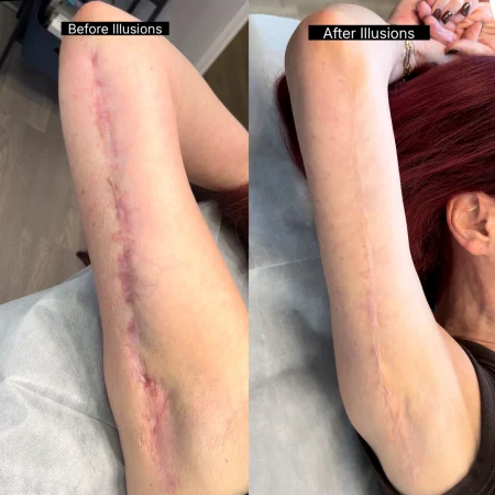 Before and after comparison showing scar camouflage results on a client’s upper arm by Illusions by Ink Studio in Dallas, TX.