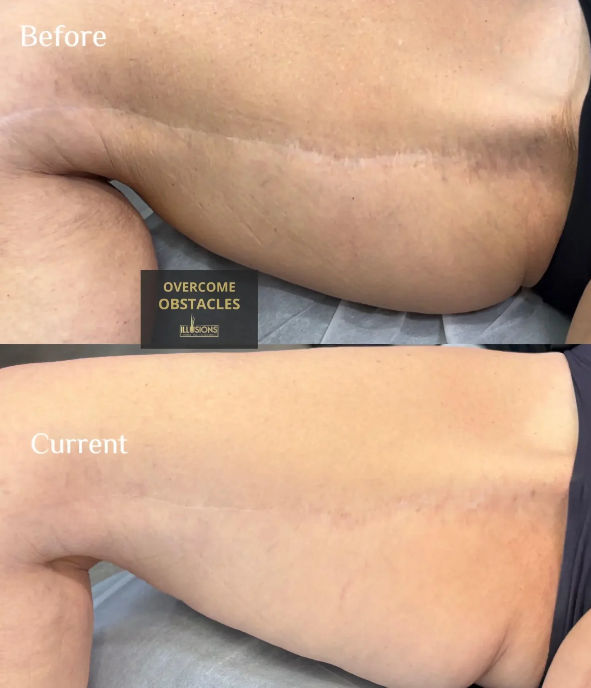 thighplasty-right-leg-before-and-after